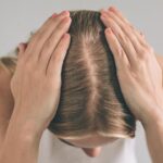 women hair loss